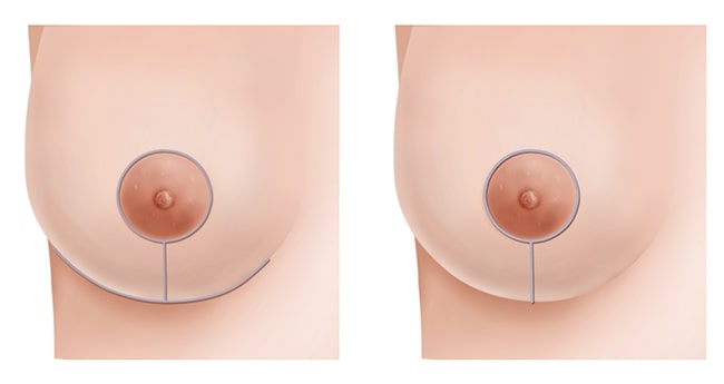 Your nipples and breast reduction