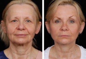 fillers facelifts facelift